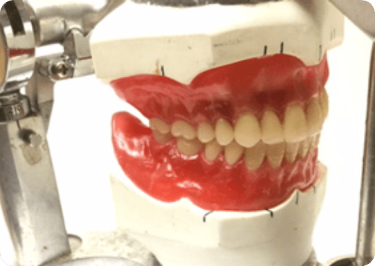 ロウ義歯での確認・試適